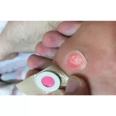 Miếng dán Giảm mụn cóc Sakura ( hộp 12 miếng) , giảm mụn cơm, trai chân, cực kì hiệu quả