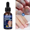 Serum Nấm Móng Tay Chân - Loại Bỏ Nhanh, Kháng Khuẩn, Miễn Phí Vận Chuyển 3