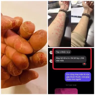 Kem bôi dị ứng Sơn gel móng tay ,lưu huynh ,nam mong ,xà phòng,hoa chất làm tóc … 4 Kem bôi dị ứng Sơn gel móng tay ,lưu huynh ,nam mong ,xà phòng,hoa chất làm tóc … 4