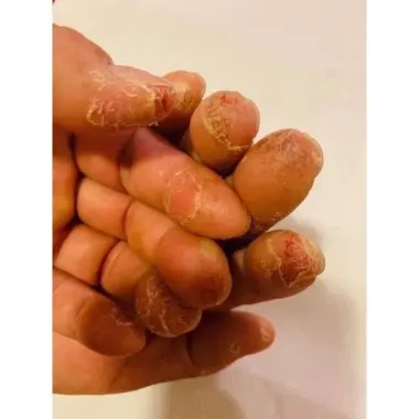 Kem bôi dị ứng Sơn gel móng tay ,lưu huynh ,nam mong ,xà phòng,hoa chất làm tóc … 7 Kem bôi dị ứng Sơn gel móng tay ,lưu huynh ,nam mong ,xà phòng,hoa chất làm tóc … 7