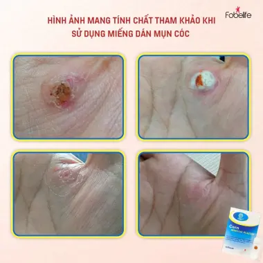 Miếng Dán Loại Bỏ Mụn Cóc Mụn Cơm KangDi Fobe - Giảm Mụn Hiệu Quả Chỉ 56k/hộp 6 Miếng 6