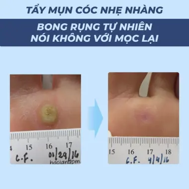 Miếng dán mụn cóc tẩy mụn cóc mụn thịt hiệu quả nhanh an toàn Bellena DC 5