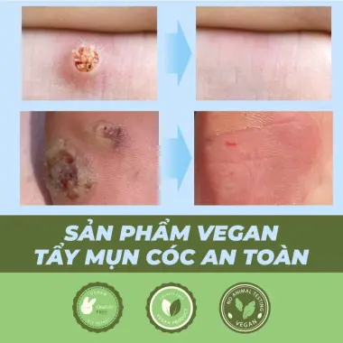 Miếng dán mụn cóc tẩy mụn cóc mụn thịt hiệu quả nhanh an toàn Bellena DC 9