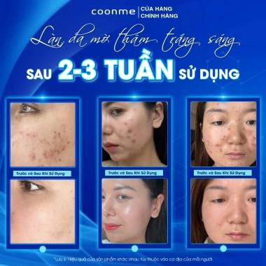 Combo mờ thâm Coonme Perfect White Serum 20ml + Kem Dark Skin 20g - Trắng da nhanh 3 Combo mờ thâm Coonme Perfect White Serum 20ml + Kem Dark Skin 20g - Trắng da nhanh 3