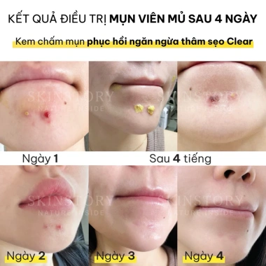 Kem chấm mụn cao nghệ Clear Skinstory giảm mụn, liền sẹo, mờ thâm, giá 225.000 VND 4