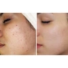 Kem mụn B.star mẫu mới hiệu quả cho mọi loại mụn, giảm giá 304.000₫ - Đánh tan mụn nhanh 4