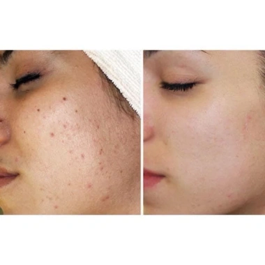 Kem mụn B.star mẫu mới hiệu quả cho mọi loại mụn, giảm giá 304.000₫ - Đánh tan mụn nhanh