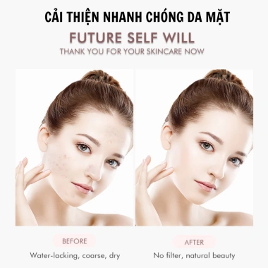 Máy Cà Da Chết Bằng Sóng Âm Xẻng Đẩy Mụn Đầu Đen, Tấy Tế Bào Làm Sạch Và Căng Da Mặt