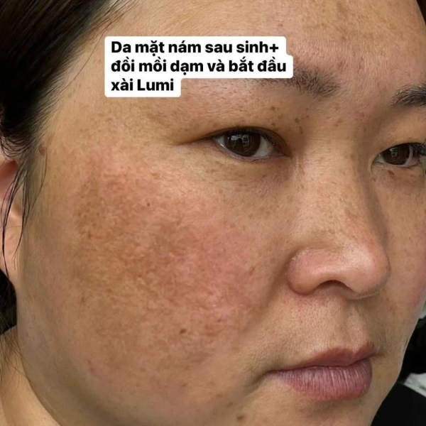 Hình ảnh sản phẩm Serum Lumi Arbutin 50ml - Cấp ẩm, Làm dịu, Da mềm mịn, Sáng khỏe - Giá 250k