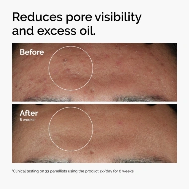 The Ordinary Niacinamide 10% + Zinc 1% 30/60ml - Giảm mụn thâm, se khít lỗ chân lông - 205.001đ