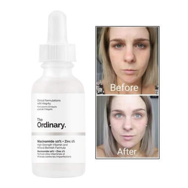 The Ordinary Niacinamide 10% + Zinc 1% 30ml - Tinh Chất Cho Da Mụn, Se Khít Lỗ Chân Lông, Sáng Da 3 The Ordinary Niacinamide 10% + Zinc 1% 30ml - Tinh Chất Cho Da Mụn, Se Khít Lỗ Chân Lông, Sáng Da 3