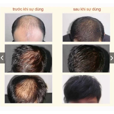 Dầu Gội Kích Mọc Tóc QIWEITANG – Dầu Gội QWEITANG Nhân Sâm Giảm Rụng, Kích Mọc Tóc Đen, Chắc Khỏe Từ Gốc 350ml