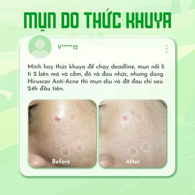 Bộ Gel Hiruscar Post Acne 5g - Giảm mụn 24h, mờ sẹo thâm, chỉ 347k