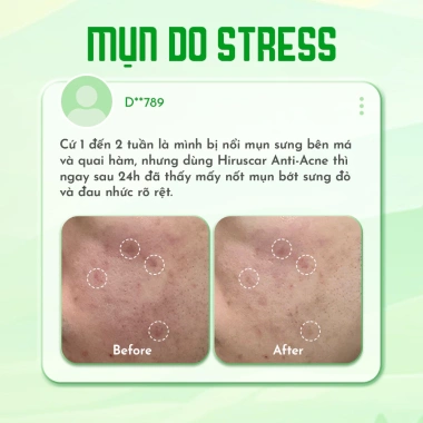 Bộ Gel Hiruscar Post Acne 5g - Giảm mụn 24h, mờ sẹo thâm, chỉ 347k