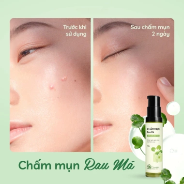 Combo Serum và Chấm Mụn Rau Má - Ngừa Mụn Cỏ Mềm, Mờ Vết Thâm, Giá 510k