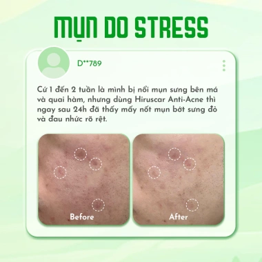 Gel giảm mụn nhanh 24h Hiruscar Anti Acne Advance Spot Gel 10g - Chỉ 162.000 VND