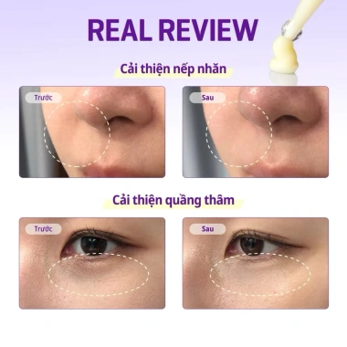 Kem mắt Some By Mi Retinol 30ml chính hãng - Ngừa lão hóa, ẩm sâu - 468.000₫ 2 Kem mắt Some By Mi Retinol 30ml chính hãng - Ngừa lão hóa, ẩm sâu - 468.000₫ 2