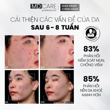 MD CARE AntiAc Exfo 10ml - Tẩy tế bào chết, kiểm soát mụn, giảm viêm, giảm dầu, giá 199.500₫ 6 MD CARE AntiAc Exfo 10ml - Tẩy tế bào chết, kiểm soát mụn, giảm viêm, giảm dầu, giá 199.500₫ 6