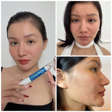 Retinol Mix Peel MOCHA - Peel da cải thiện mụn, nám, dưỡng da tại nhà, mua 1 tặng 3 chỉ 350.000₫ 2 Retinol Mix Peel MOCHA - Peel da cải thiện mụn, nám, dưỡng da tại nhà, mua 1 tặng 3 chỉ 350.000₫ 2