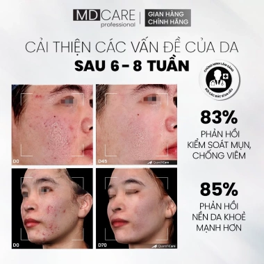 Tẩy Tế Bào Chết MD CARE AntiAc Exfo 30ml Kiểm Soát Mụn Giảm Viêm Giảm Dầu Giá 199k