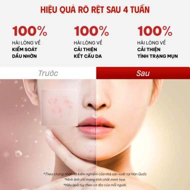 Tinh chất 17Hours Red Spot serum Aczero 4‑Terpeneol + Tea Tree Oil, làm dịu da, giảm vết đỏ 30ml - 435.500₫