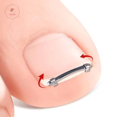 AACAR Dụng Cụ Làm Móng Chân Mọc Ngược - Kẹp Chỉnh Sửa Móng Tay, Kẹp Cong, Giá Ưu Đãi 46.934 VND