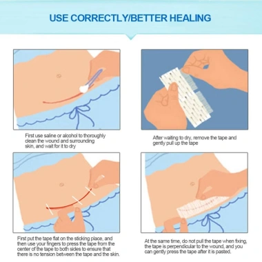 Băng Y Tế Không Đường May 5 Kích Cỡ Sau Sinh, Vết Thương, Dây Kéo Chặt 3 Băng Y Tế Không Đường May 5 Kích Cỡ Sau Sinh, Vết Thương, Dây Kéo Chặt 3