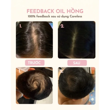 [BEST SELLER] Dầu OIL HỒNG Ủ Tóc Rosemary - Dưỡng Da Đầu Dầu, Kích Mọc, Dày Chân Tóc, Giảm Gãy Rụng - 79.000đ 3