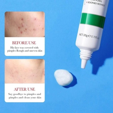 BIOAOUA Kem Saucylic Acid loại bỏ mụn nhẹ nhàng, phai màu, cải thiện da, chống mụn dầu - Giá 60.500 VND
