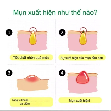 Bộ 3 trong 1 Điều Mụn Chống Mụn - Kem Dưỡng Da và Gel Loại Bỏ Mụn Dầu Tràm, Giá chỉ 60.500₫ 4