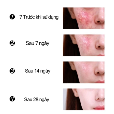 Bộ 3 trong 1 Điều Mụn Chống Mụn - Kem Dưỡng Da và Gel Loại Bỏ Mụn Dầu Tràm, Giá chỉ 60.500₫ 5