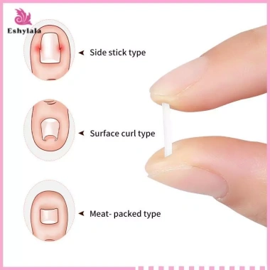Bộ 50 dụng cụ chỉnh sửa móng chân mọc ngược - miếng dán đàn hồi, thẳng, kẹp nẹp, giá chỉ 35.900 VND 4 Bộ 50 dụng cụ chỉnh sửa móng chân mọc ngược - miếng dán đàn hồi, thẳng, kẹp nẹp, giá chỉ 35.900 VND 4