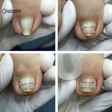 Bộ dụng cụ niềng móng chân 10pcs - Sửa lỗi móng chân mọc ngược, chỉ 100.000đ