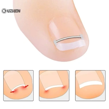 Bộ dụng cụ niềng móng chân 10pcs - Sửa lỗi móng chân mọc ngược, chỉ 100.000đ 4 Bộ dụng cụ niềng móng chân 10pcs - Sửa lỗi móng chân mọc ngược, chỉ 100.000đ 4