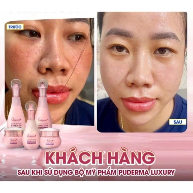 Bộ Kem Dưỡng Da Cao Cấp Puderma Luxury Exosome – Nâng Cơ Giảm Nhăn Tái Tạo Mờ Thâm Nám – Giá 719.800₫ 9