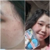 Bộ kem mụn sẹo thâm chuyên sâu Thái Lan chính hãng - Giá ưu đãi 395k giảm từ 474k 2