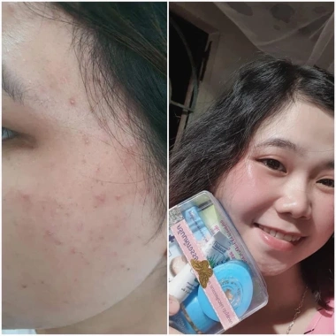 Bộ kem mụn sẹo thâm chuyên sâu Thái Lan chính hãng - Giá ưu đãi 395k giảm từ 474k 2