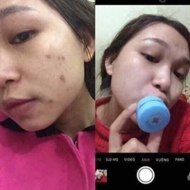 Bộ kem mụn sẹo thâm chuyên sâu Thái Lan chính hãng - Giá ưu đãi 395k giảm từ 474k 4
