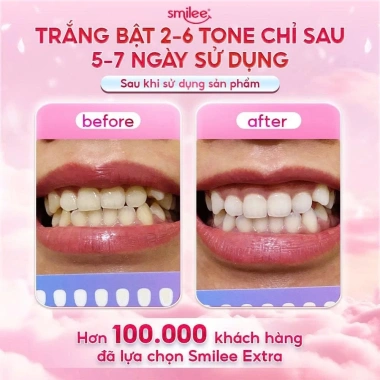Bộ trắng răng Smilee Extra 2-6 tone tại nhà, kèm 3 bút gel LIS - Giá chỉ 950.000đ
