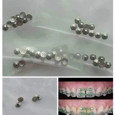 Button chỉnh nha, túi 10 cái - Giá ưu đãi 48.000 VND, an toàn, dễ dùng 2