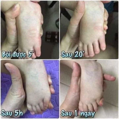 Cao bôi muỗi đốt côn trùng Thái Lan 20g - 55.000, diệt muỗi nhanh, không kích ứng