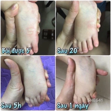 Cao bôi muỗi đốt Thái Lan - Hiệu quả xua đuổi muỗi, không mùi, giảm giá 45.000đ