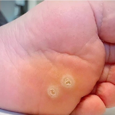 CHÍNH HÃNG Miếng dán giảm mụn cóc Plasters 18 miếng - Hiệu quả giảm mụn cơm, chống hàng giả, giá ưu đãi 240k 2