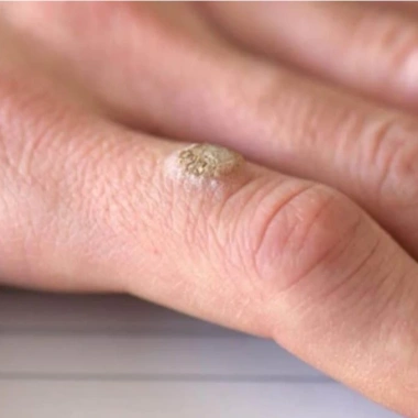 CHÍNH HÃNG Miếng dán giảm mụn cóc Plasters 18 miếng - Hiệu quả giảm mụn cơm, chống hàng giả, giá ưu đãi 240k 4