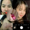 Combo 3 hộp Kem Mụn 2C kèm quà tặng, giảm nám tàn nhang, trắng da chỉ 219.000 4