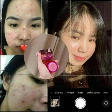 Combo 3 hộp Kem Mụn 2C kèm quà tặng, giảm nám tàn nhang, trắng da chỉ 219.000 4 Combo 3 hộp Kem Mụn 2C kèm quà tặng, giảm nám tàn nhang, trắng da chỉ 219.000 4