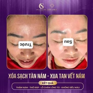 Combo Cerave Serum và Kem Dưỡng Da Giảm Nám Tàn Nhang và Nếp Nhăn 30ml và 30g Giá 850k 5 Combo Cerave Serum và Kem Dưỡng Da Giảm Nám Tàn Nhang và Nếp Nhăn 30ml và 30g Giá 850k 5