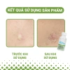 Combo Chấm Giảm Mụn Viêm và Thâm Nhanh 30ml Tràm Trà và Vitamin C Giá 1tr 5