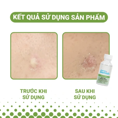 Combo Chấm Giảm Mụn Viêm và Thâm Nhanh 30ml Tràm Trà và Vitamin C Giá 1tr