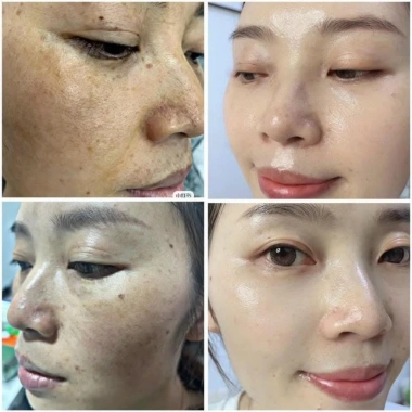 Combo Chăm Sóc Da MIESHO HA 4 món - Dưỡng ẩm, cải thiện da tối màu, nâng tông nhẹ nhàng, giá chỉ 750.000 VND